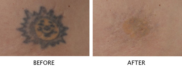 Laser Tattoo Removal | Salmon Creek Plastic Surgery