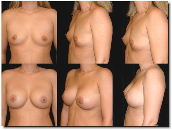 Should I Do The Master Cleanse After Breast Augmentation 33