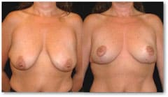 breast_lift2