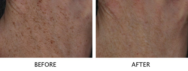 Laser Brown Spot Removal Example