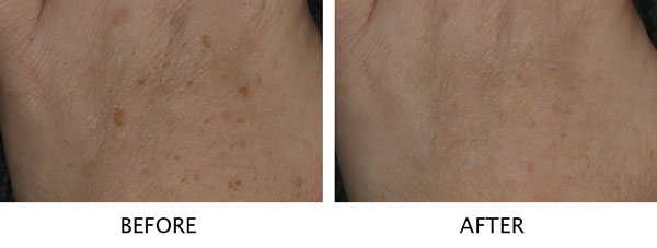 Laser Brown Spot Removal Example on Hand