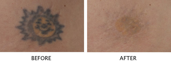 Tattoo removal example of sun