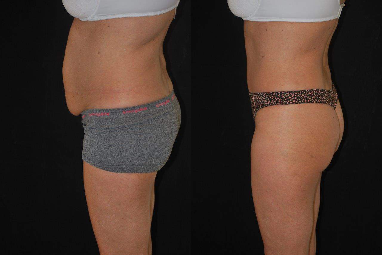 Tummy Tuck Before and After Photos - Portland Plastic Surgery