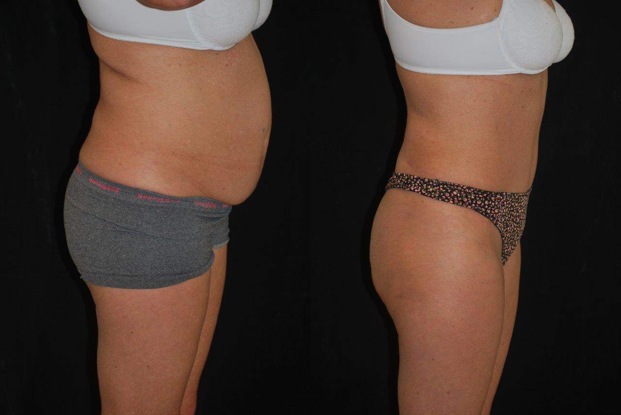 tummy tuck