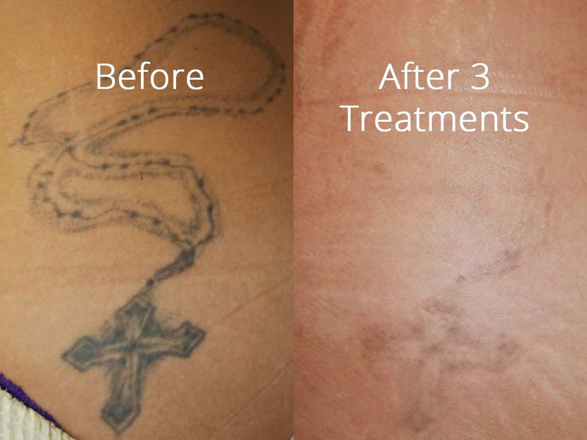 Before and After of Tattoo Removal