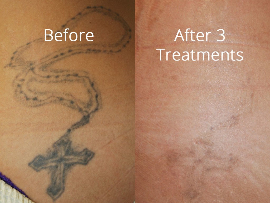 Tattoo Removal Before and After | Salmon Creek Plastic Surgery