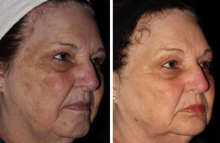 Treat Brown Spots and Melasma with PICO Genesis™ Laser Salmon Creek Plastic Surgery