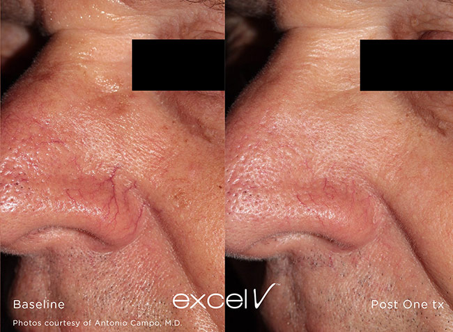 Excel V Treatment on Veins on Nose