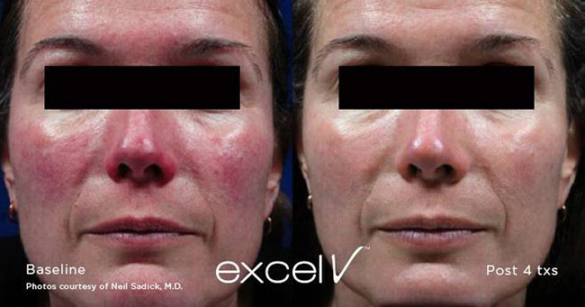 Excel V treatment of Rosacea