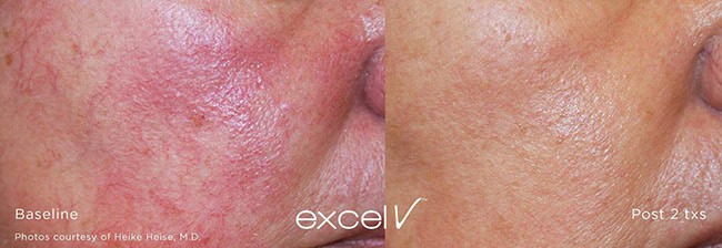 Excel V treatment of Rosacea