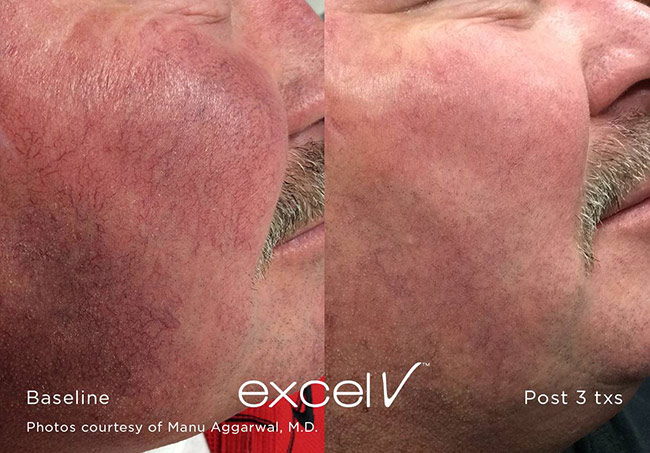 Excel V Treatment on Veins in Face