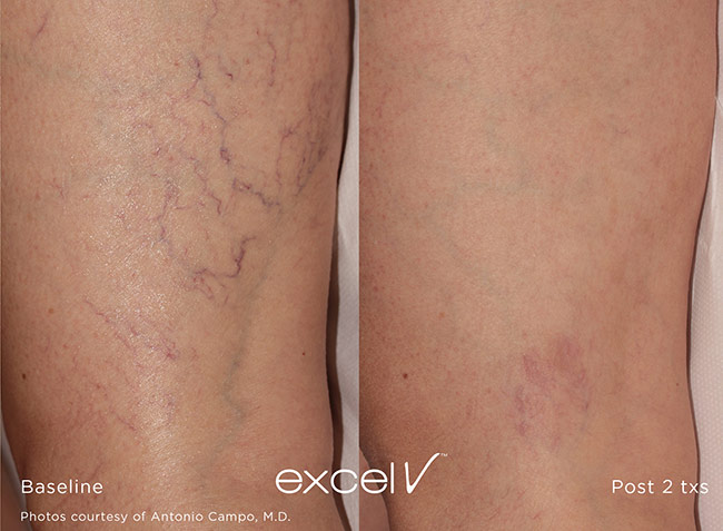 Excel V Treatment on Veins on Legs