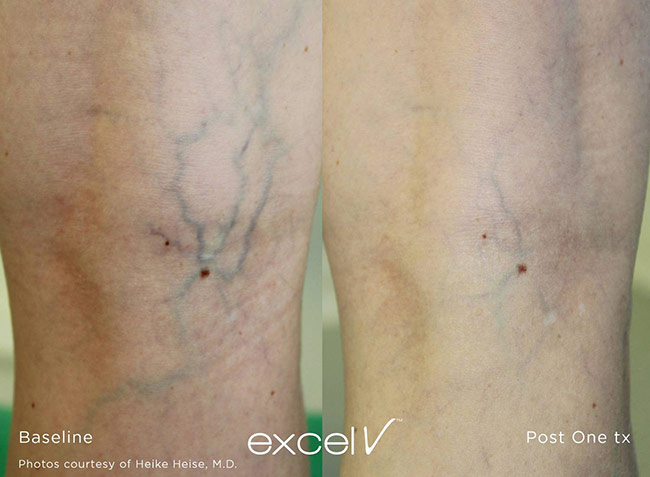 Excel V Treatment on Veins on Legs