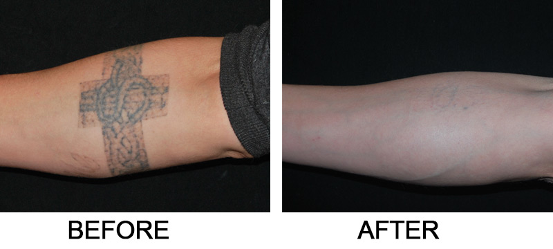 Tattoo removal on arm