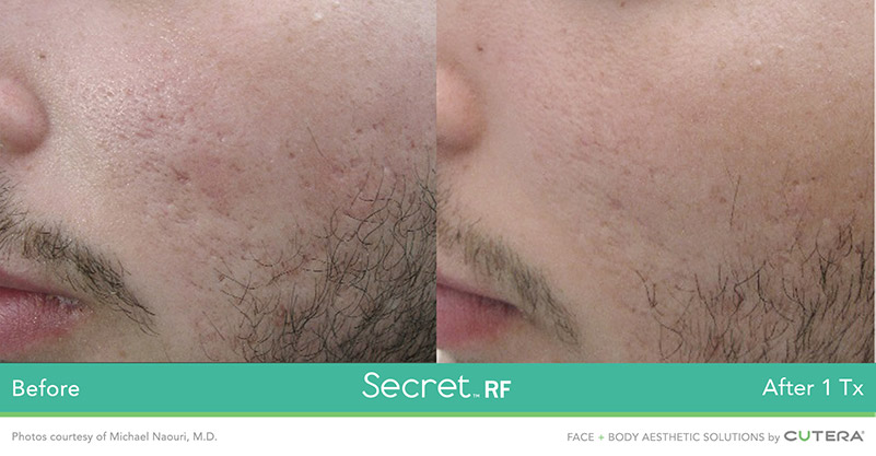 Secret Acne Scarring Before and After
