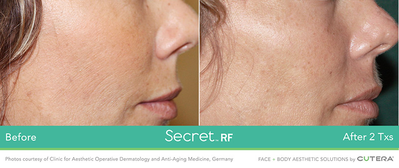 Secret RF Cheek Before and After