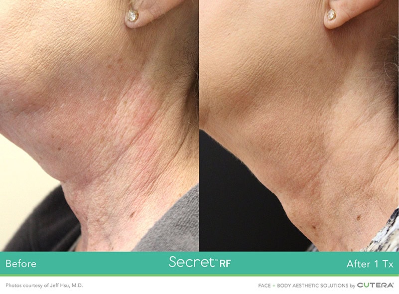 Secret RF Neck Before and After