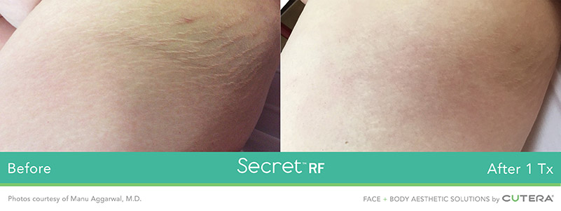 Secret RF Stretch Marks Before and After