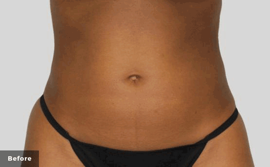 Hips Trusculpt Before & After