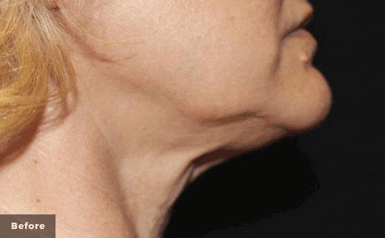 Trusculpt Neck Before and After