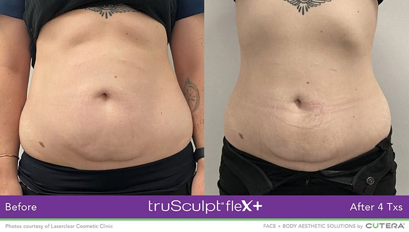 Muscle Sculpting Female Abs 2 Before and After