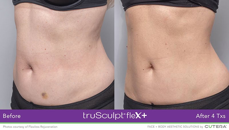 Muscle Sculpting Female Abs Before and After