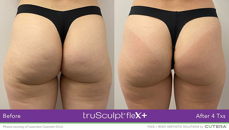 truSculpt flex Female Glutes Before and After