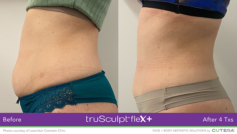 truSculpt flex Female Side 2 Before and After