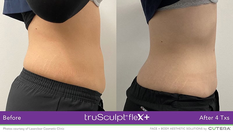 truSculpt flex Female Side Before and After