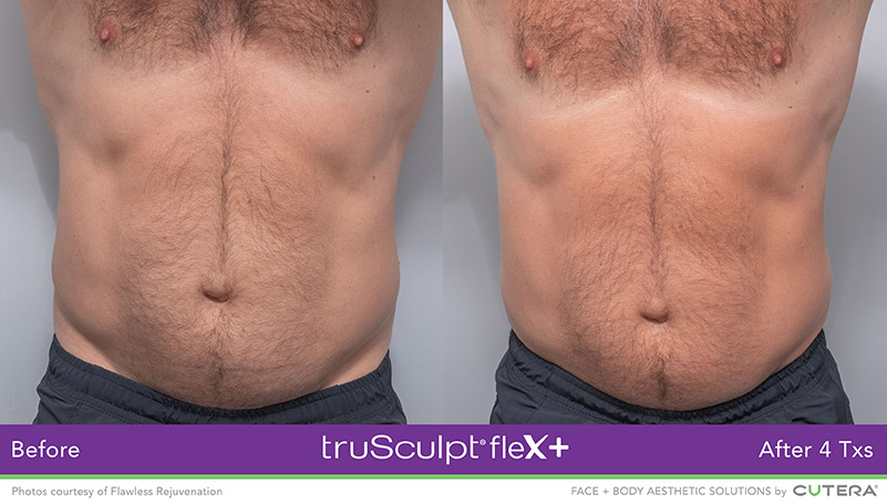 truSculpt Male Abs Before and After