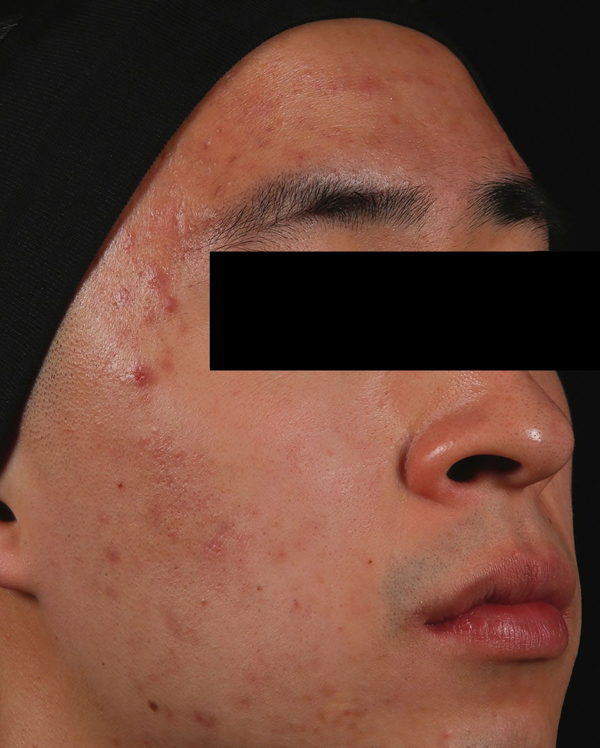 Aviclear After 1 Aviclear After 1