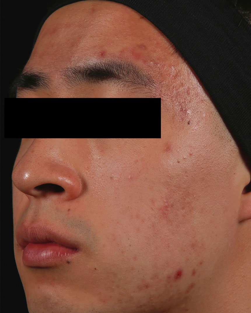 Acne Treatment After Acne Treatment After