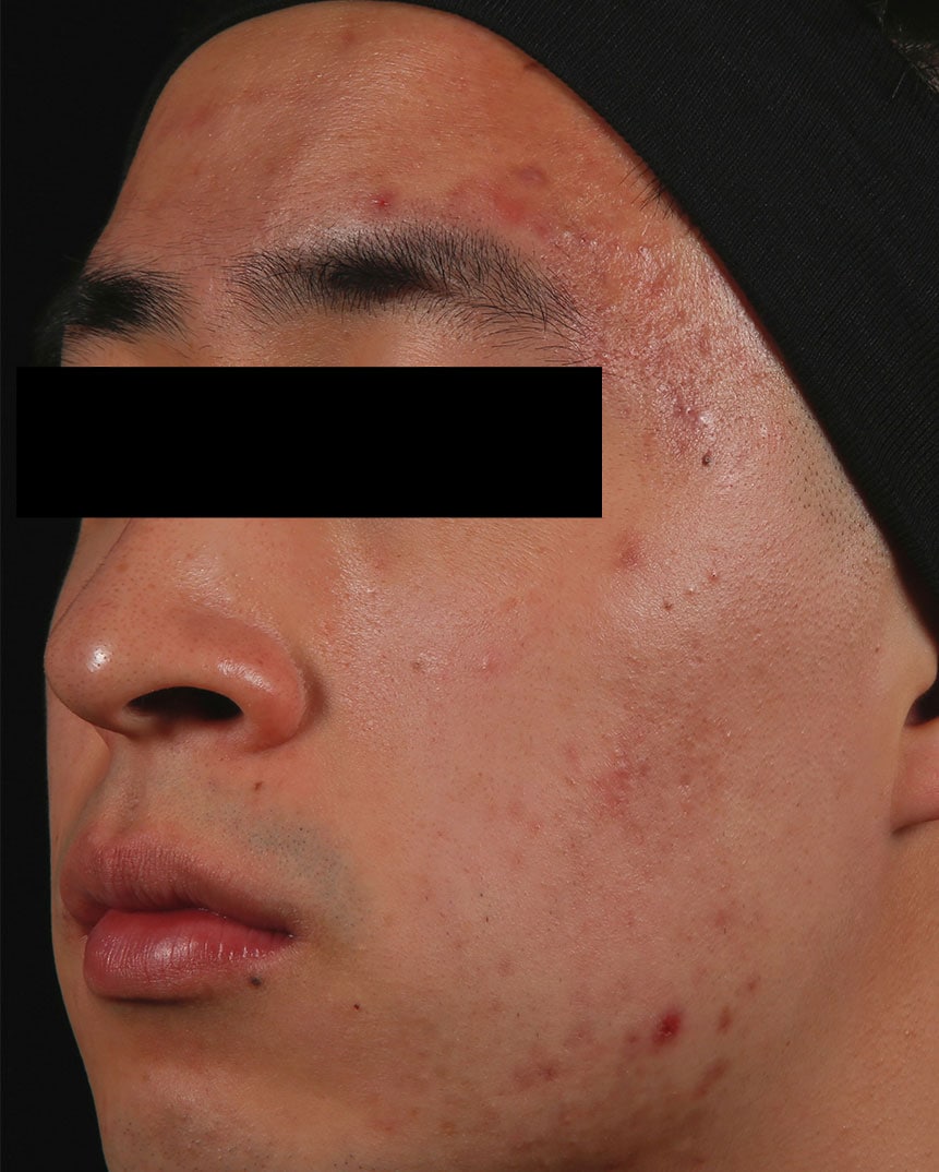 Acne Treatment After