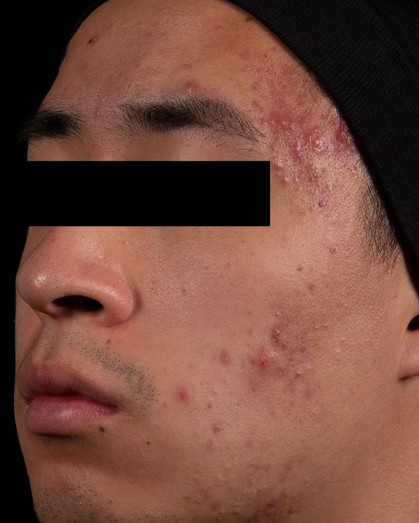 Acne Treatment Before