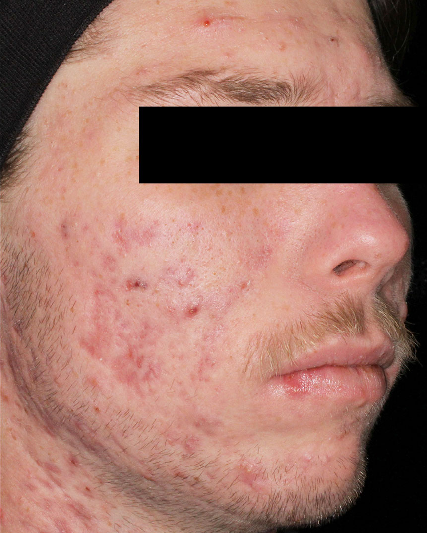 Aviclear treatment after 2