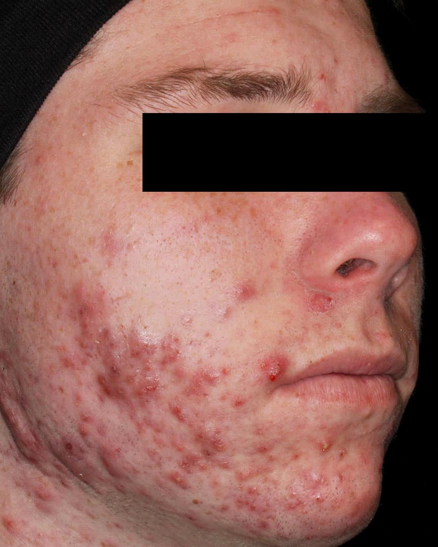 Aviclear treatment before 2 Aviclear treatment before 2