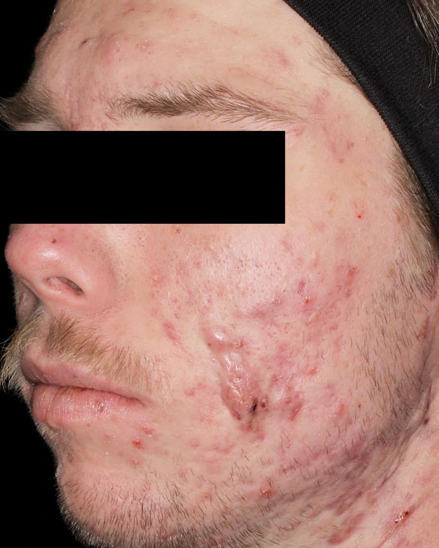 Aviclear treatment after 3 Aviclear treatment after 3
