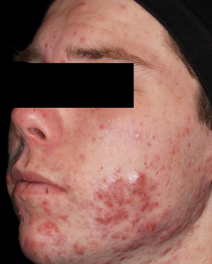Aviclear treatment before 3 Aviclear treatment before 3