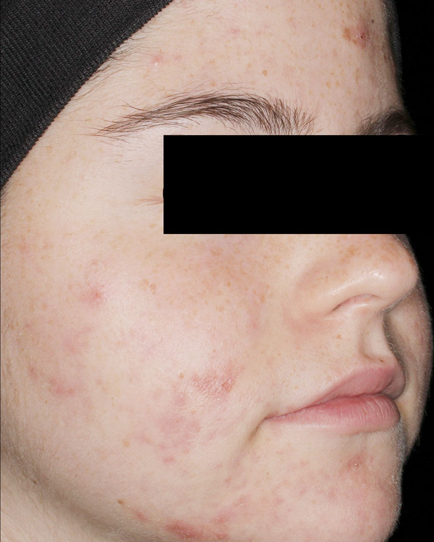 Aviclear acne treatment after 4