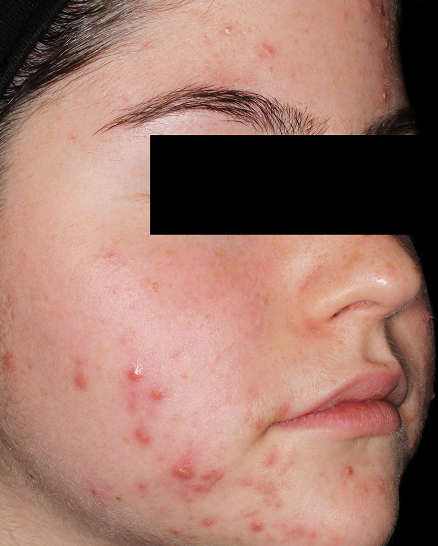 Aviclear acne treatment before 4