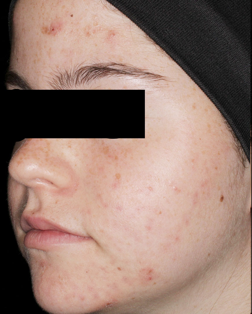 Acne laser treatment after photo