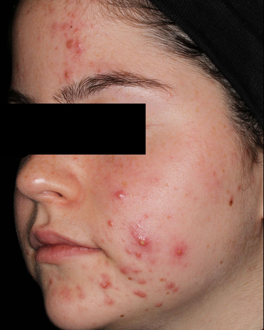 Acne laser treatment before photo