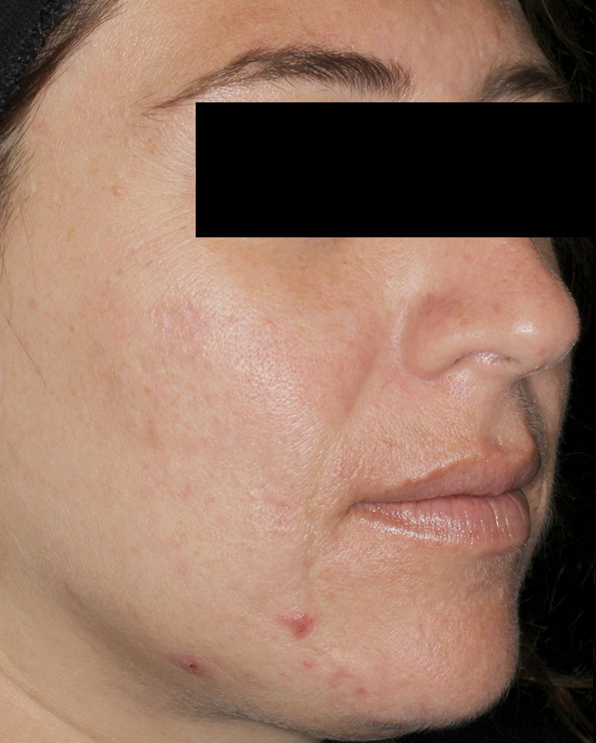 Aviclear acne treatment after 6