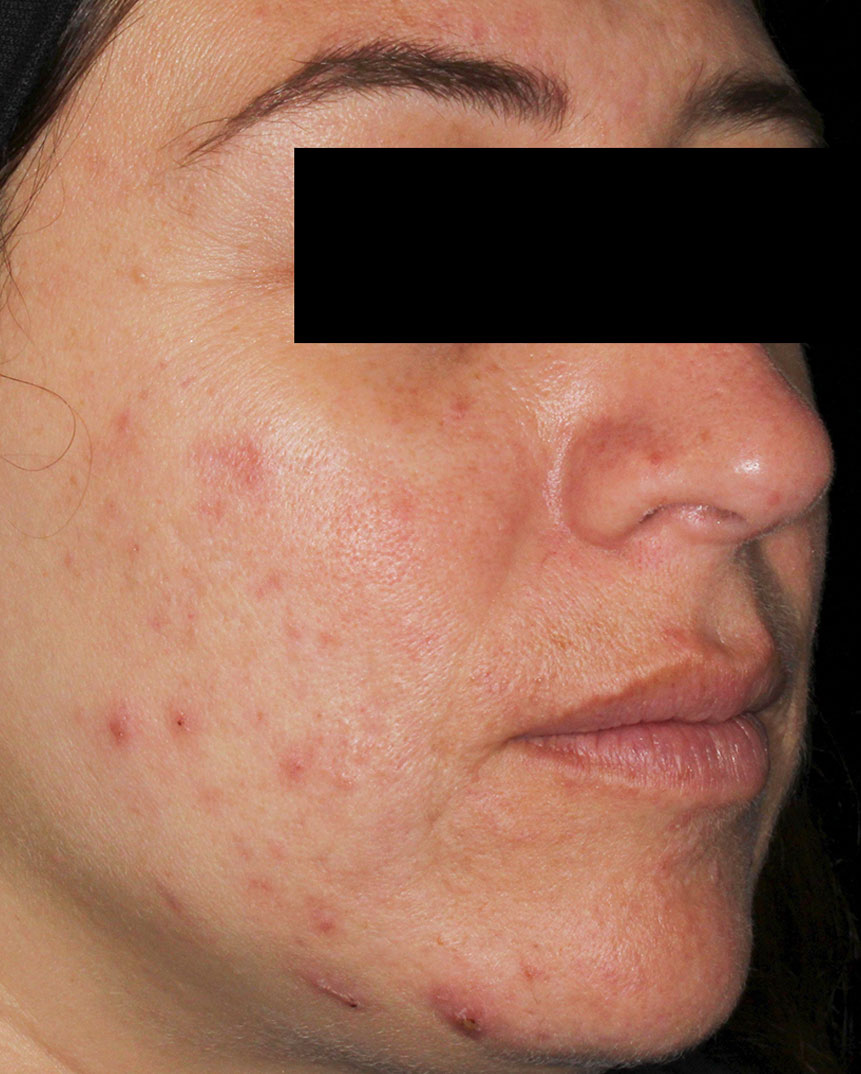 Aviclear acne treatment before 6