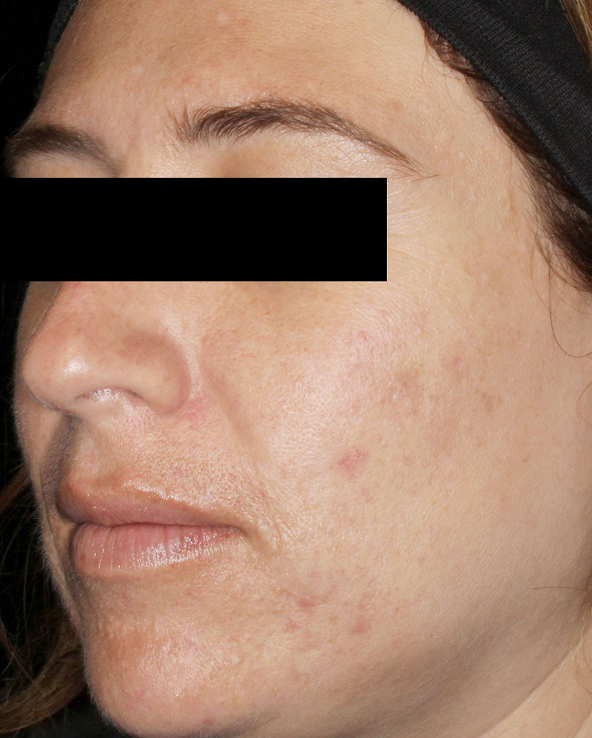 Aviclear acne treatment after 7