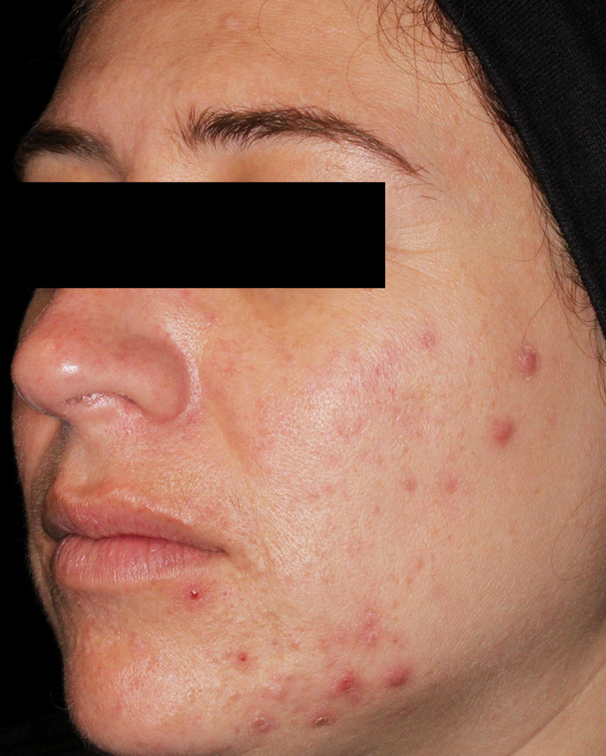 Aviclear acne treatment before 7