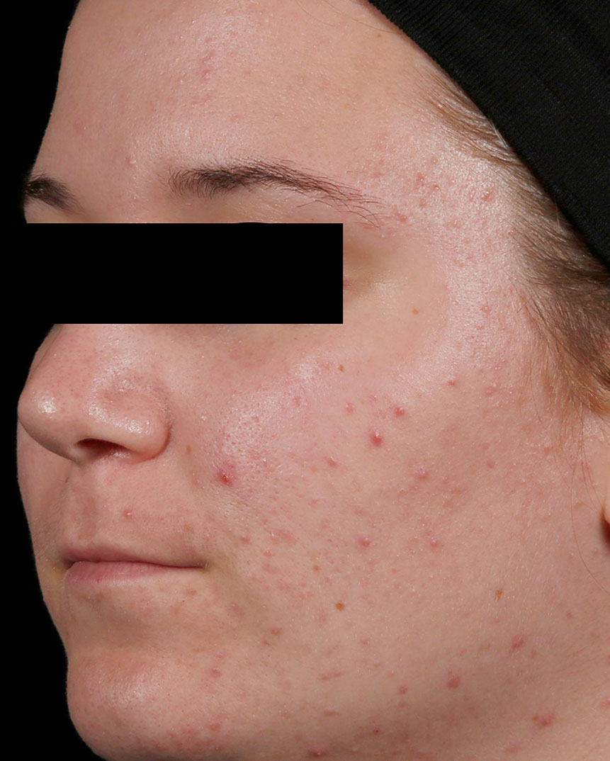 AviClear acne treatment after image
