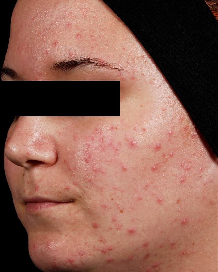 AviClear acne treatment before image AviClear acne treatment before image